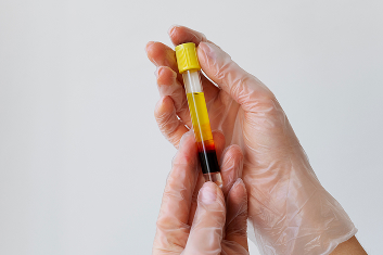 Hematuria (Blood in Urine): What It Means and When to See a Doctor