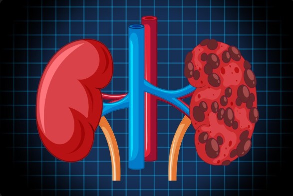 Do All Kidney Patients Need Dialysis? Myths Explained